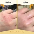 thumbnail image 5 of Eczema Honey Skin-Soothing & Itch-Cooling Cream for Eczema-Prone Skin, 2 oz, 5 of 7