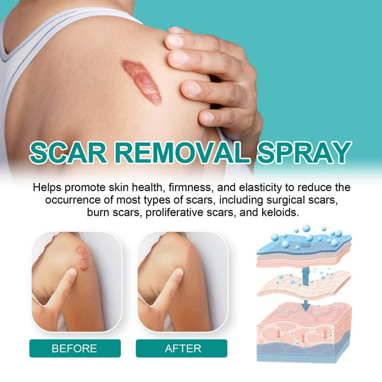 ScarAway Silicone Scar Spray