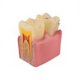 thumbnail image 2 of Dental Tooth Decay Model 6 Times Dental Caries Teeth Model, 2 of 7