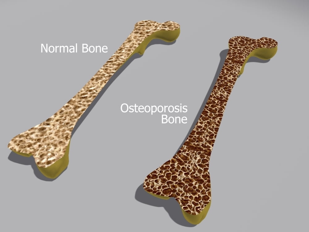 Comparison of a healthy bone and a bone with osteoporosis. Osteoporosis leads to a decrease in