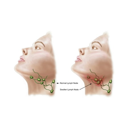 Anatomy of swollen lymph nodes Stretched Canvas - Stocktrek Images (18 x