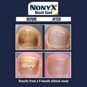 Nonyx Nail Gel, a Clinically Proven Treatment for Fungus-Damaged Nails, 4 oz.