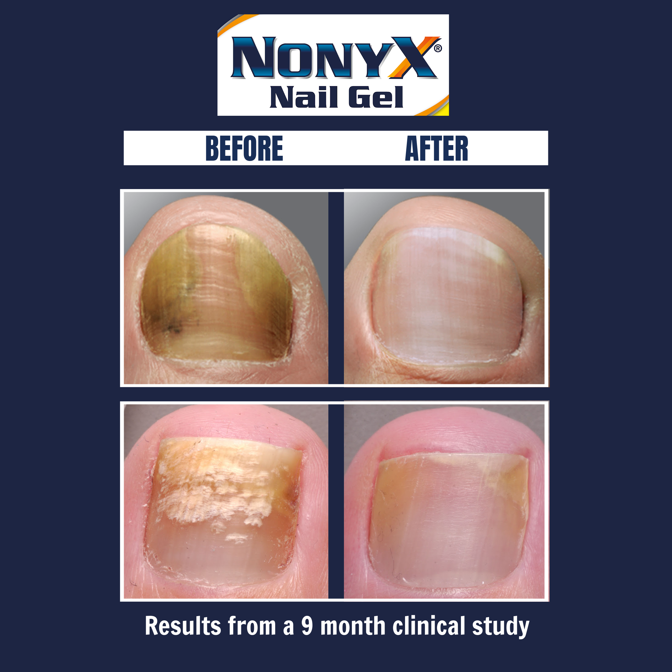 Nonyx Fungal Nail Clarifying Gel | Clinically Proven Effective for Fungus Damaged Toenails | Results are Money-back Guaranteed, 4 oz. - image 4 of 9