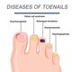 thumbnail image 4 of Nail Fungus Light Th, 4 of 5