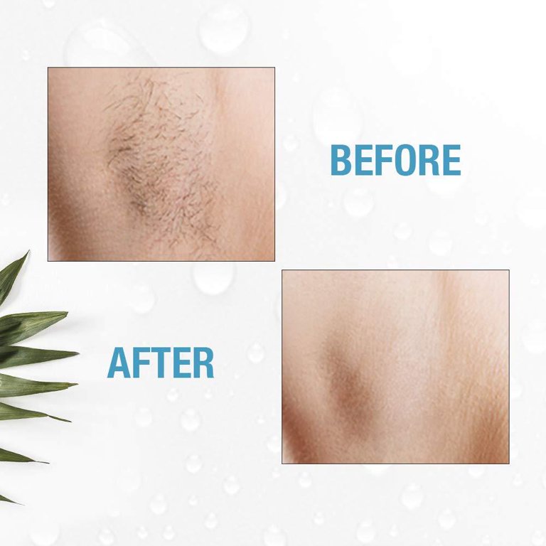 Full Body Electrolysis