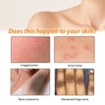 thumbnail image 4 of Loción corporal antiacné para eliminar granitos, espalda y glúteos, hidratante, blanqueadora, para aclarar manchas oscuras y melanina en las articulaciones, loción para el tratamiento del acné, 4 of 4