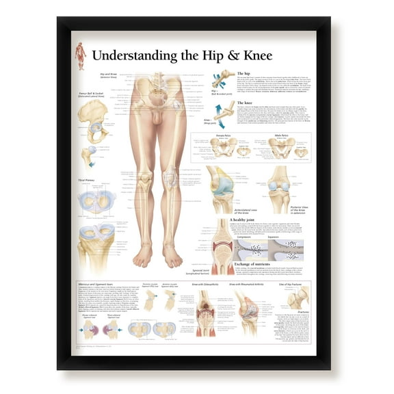 Framed Medical Poster Understanding The Hip and Knee 22"x28" Wall Diagram Educational Informational Doctors Office Chart