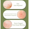 thumbnail image 2 of Cara del gel del retiro de la cicatriz del acné del árbol del té para reparar cicatrices y hoyos del acné 15g, 2 of 5