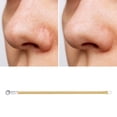 thumbnail image 5 of Unique Bargains 1 Pc Facial Double-headed Pimple Extractor Gold Tone, 5 of 7