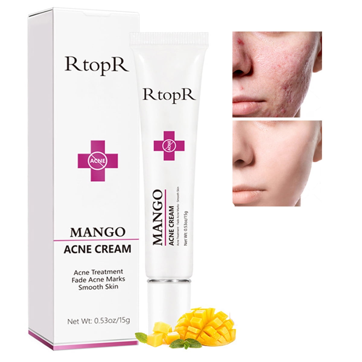 Mango Repair Acne Cream, Face Pimple Removal Cream Acne Scar Treatment