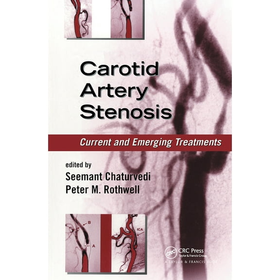 Neurological Disease and Therapy Carotid Artery Stenosis: Current and Emerging Treatments, (Hardcover)