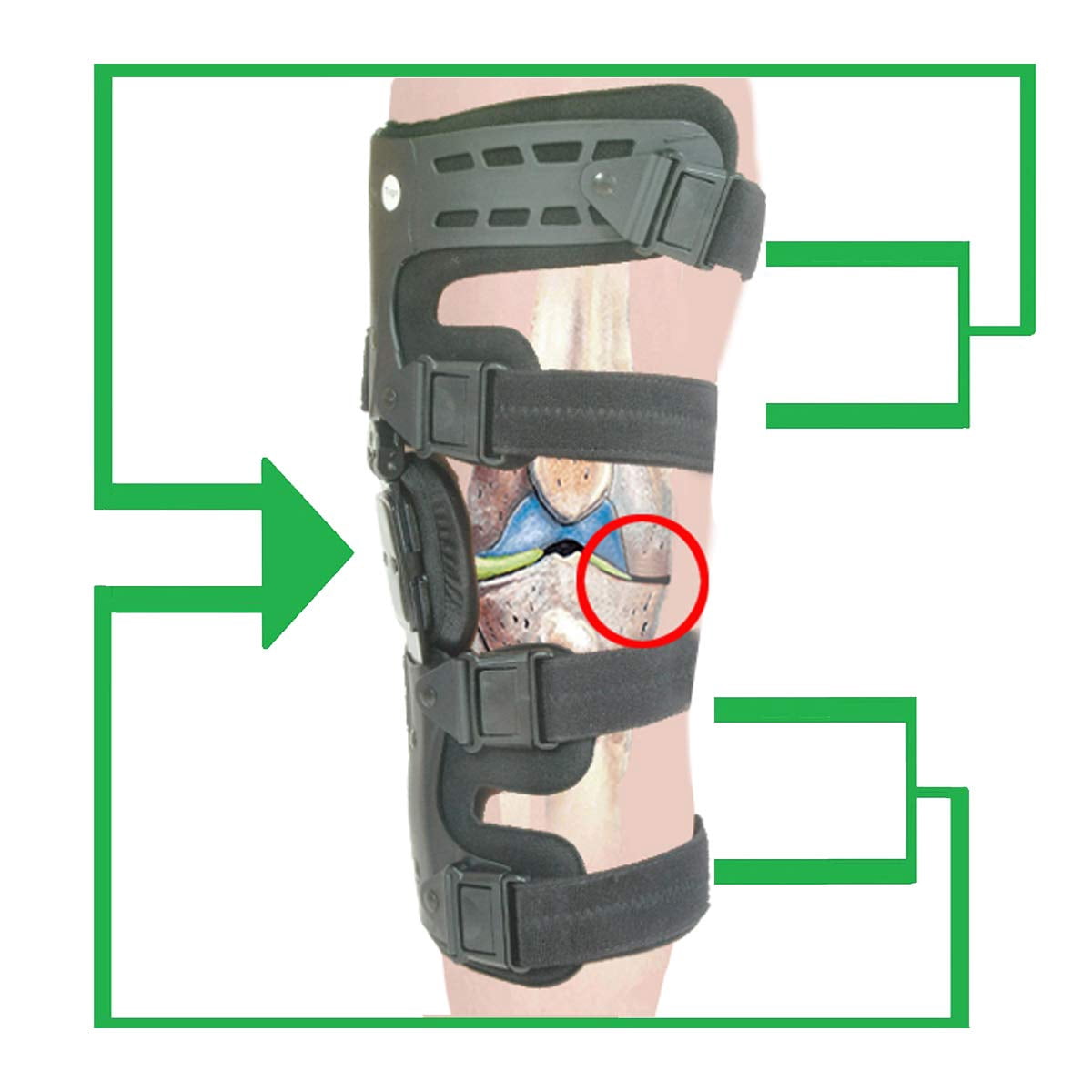 Insunen Lateral Unloader Knee Brace for Osteoarthritis & Bone on Bone Joint Degeneration Offloader with Built in Hex Key L1851 L1843 Outside, Right