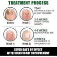thumbnail image 4 of Nail Fungus Treatment, Ginger Nail Fungus Treatment, Toenail Cuticle Care Oil Care, Fungal Nail Treatment, 7 Days Nail Fungus Treatment for Toenail, 4 of 5