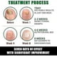 thumbnail image 4 of Nail Fungus Treatment, Ginger Nail Fungus Treatment, Toenail Cuticle Care Oil Care, Fungal Nail Treatment, 7 Days Nail Fungus Treatment for Toenail, 4 of 5