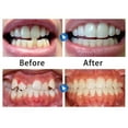 thumbnail image 2 of Xingzhi 3-In-1 Retainer Tooth Aligners Trays Straighten Corrector Mouth Guard, 2 of 6