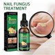 thumbnail image 2 of 30 ml Cuidado de uñas Reparación Antifúngico de uñas Eliminación de onicomicosis Líquido de jengibre Tratamiento antifúngico para uñas Aceite de jengibre para el cuidado de cutículas, 2 of 5