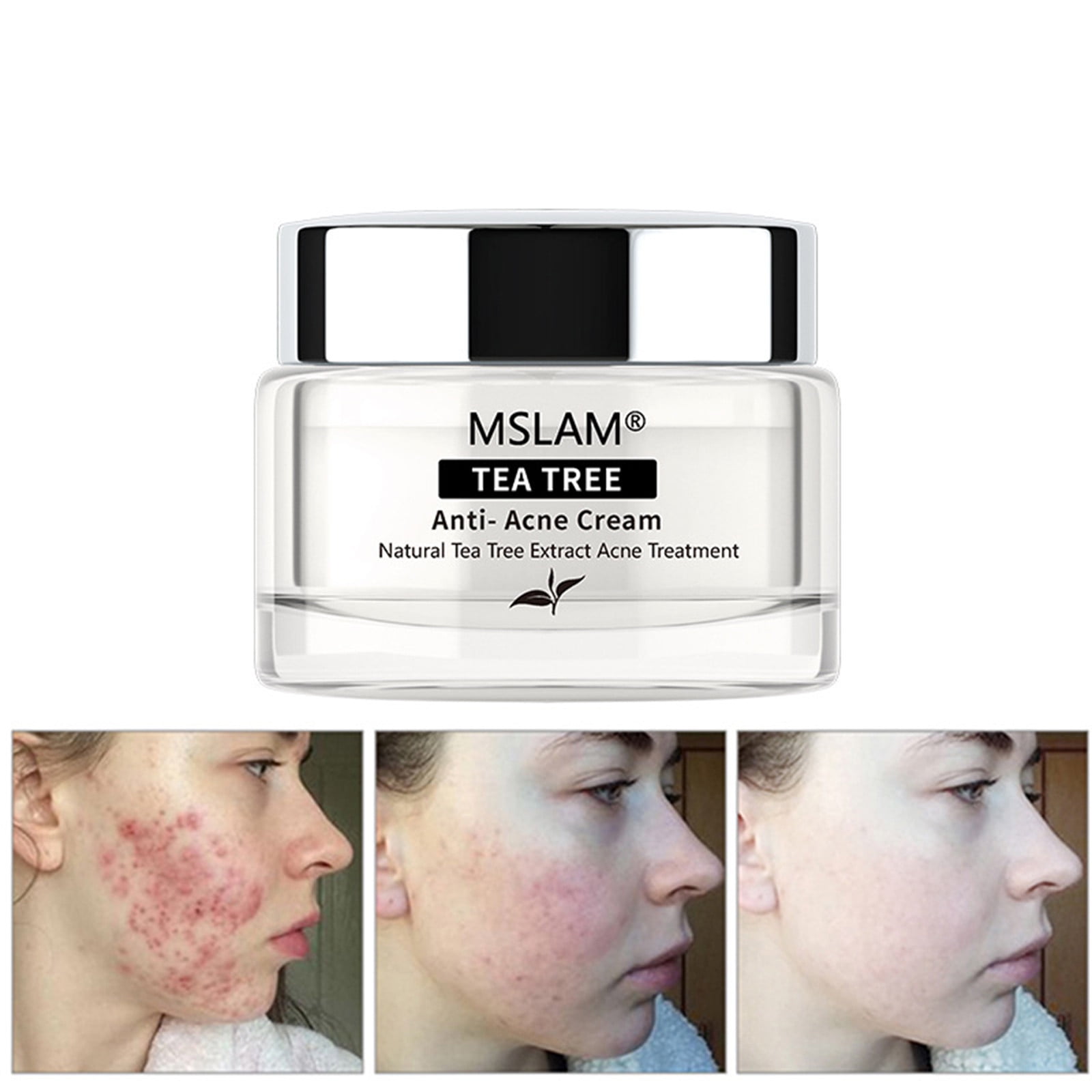 Kehuoyezai Acne Scar Removal Cream Acne Cream Herbal Acne Cream To