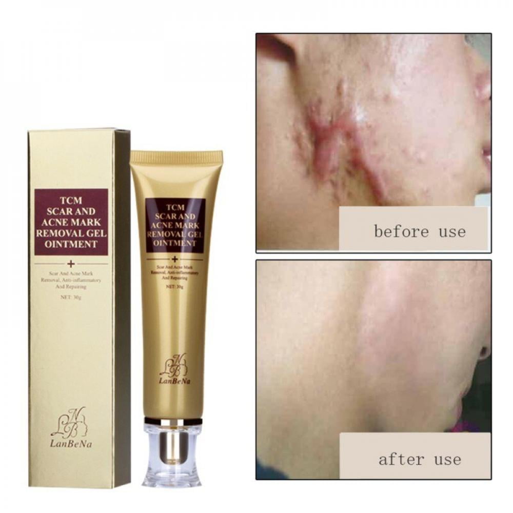 [Big Clear!]30g Scar Acne Masque Removal Gel  Skin Repair Stretch Masque Blemish