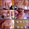 thumbnail image 4 of Nail Fungus Remover Nail Removal Cream Nail Repair Cream, 4 of 5