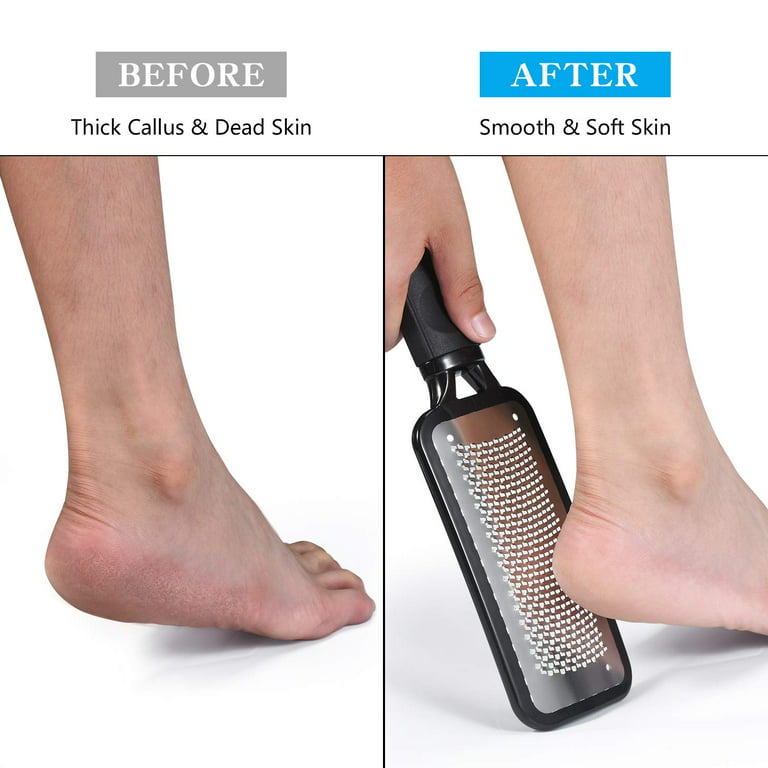 Callus Remover File Tool, Colossal Foot Rasp, Foot Scrubber, Heel Scraper, Pedicure Exfoliator to Remove Dead Hard Skin, Medical Stainless Steel Grade