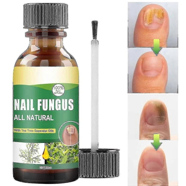 30ml Toenail Fungus Treatment, Tea Tree Oil For Toenail Fungus, Antifungal Nail Solution Care Essence