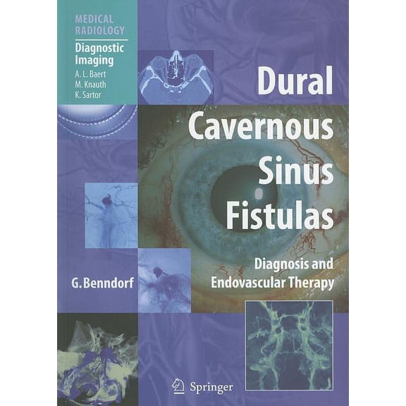 Dural Cavernous Sinus Fistulas: Diagnosis and Endovascular Therapy, (Paperback)