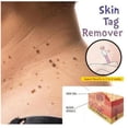 thumbnail image 2 of 10 ml Eliminador de verrugas cutáneas Sincero Líquido para eliminar verrugas cutáneas, 2 of 8