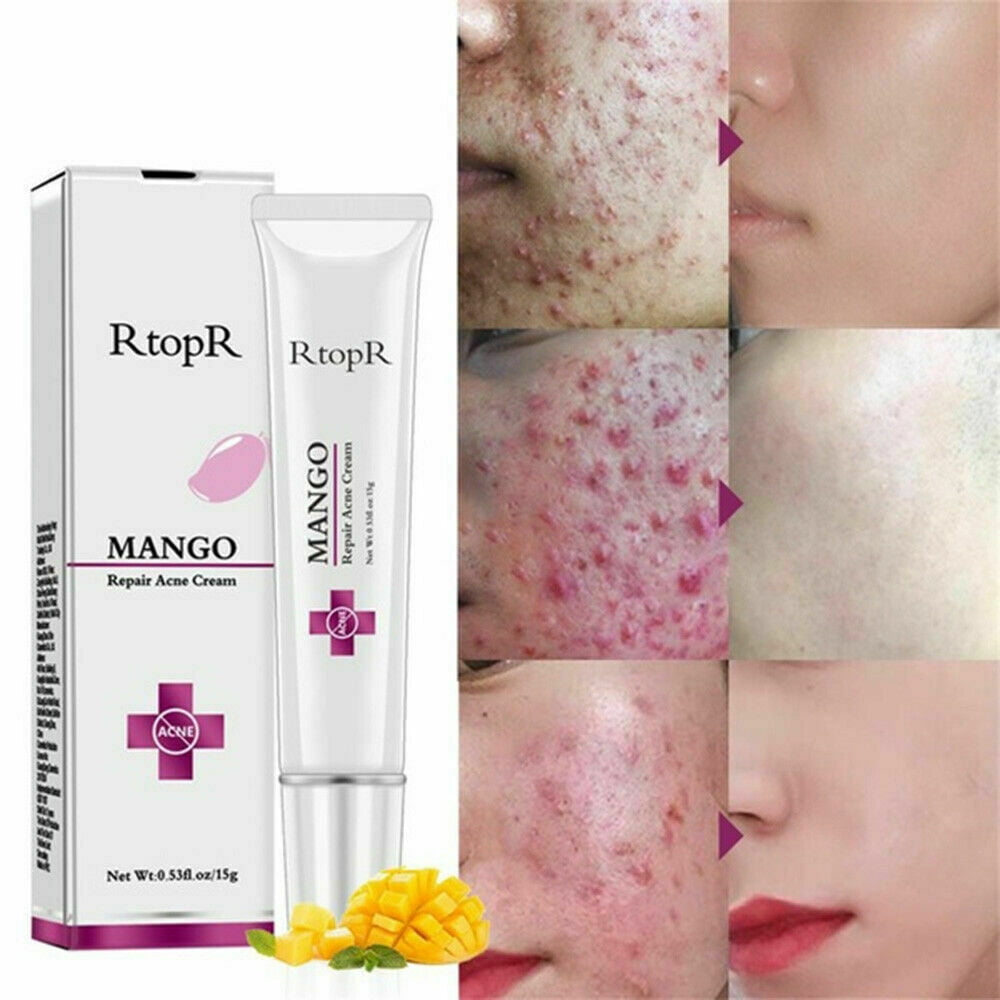 Face Skin Care Removal Cream Acne Spots Scar Stretch Marks Treatment 15 B2♚