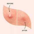 thumbnail image 4 of CYC Pimple Cover Hydrocolloid Patch For Face Blemishes Zits Absorbing Patch Breakouts For Skin Care Facial Sticker, 4 of 5