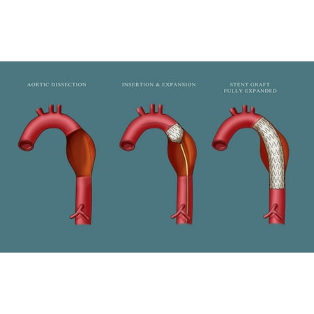 Aortic Aneurysm Stent Illustration Poster Print by Monica SchroederScience