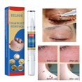 thumbnail image 4 of Removedor de verrugas Skin Tag Pen Professional Papillomas Moles Removal Pen (02) Ndcxsfigh Nuevos Originales, 4 of 8