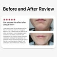 thumbnail image 5 of DUALSONIC Professional Gold HIFU Home Care Device – Deep Lifting & Skin Firming Technology, 5 of 9