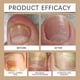 thumbnail image 2 of Onychomycosis Care Spray, Nail Spray Soft Nail Thick Nail Antibacterial Spray, 2 of 5