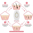 thumbnail image 3 of Depilación láser para mujeres y hombres, depilación IPL en el hogar Dispositivo de depilación permanente sin dolor en axilas Piernas traseras Brazos Cara Línea de bikini Namotu XM016, 3 of 7