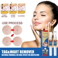 thumbnail image 3 of Removedor de verrugas Skin Tag Pen Professional Papillomas Moles Removal Pen (03) Ndcxsfigh Nuevos Originales, 3 of 9
