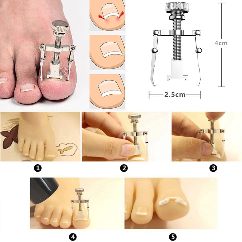 8pcs/set Professional Pedicure Tools Ingrown Toenail Tools Kit Nail Care Ingrown Toenail Removal Correction Clippers Foot Care Foot Care Tool AliExpress | Ingrown Toenails Set, Manicure Made Of High-quality Stainless Steel For 8pcs/set Professional Pedicure Tools Ingrown Toenail Tools Kit Nail Care Ingrown Toenail Removal Correction Clippers Foot Care Foot Care Tool AliExpress | Ingrown Toenails Set, Manicure Made Of High-quality Stainless Steel For