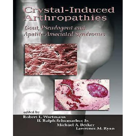 Crystal-Induced Arthropathies: Gout, Pseudogout and Apatite-Associated Syndromes