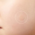 thumbnail image 1 of Patch 36Pcs   Invisible  Removal Stickers Pimple Remover Tool, 1 of 7
