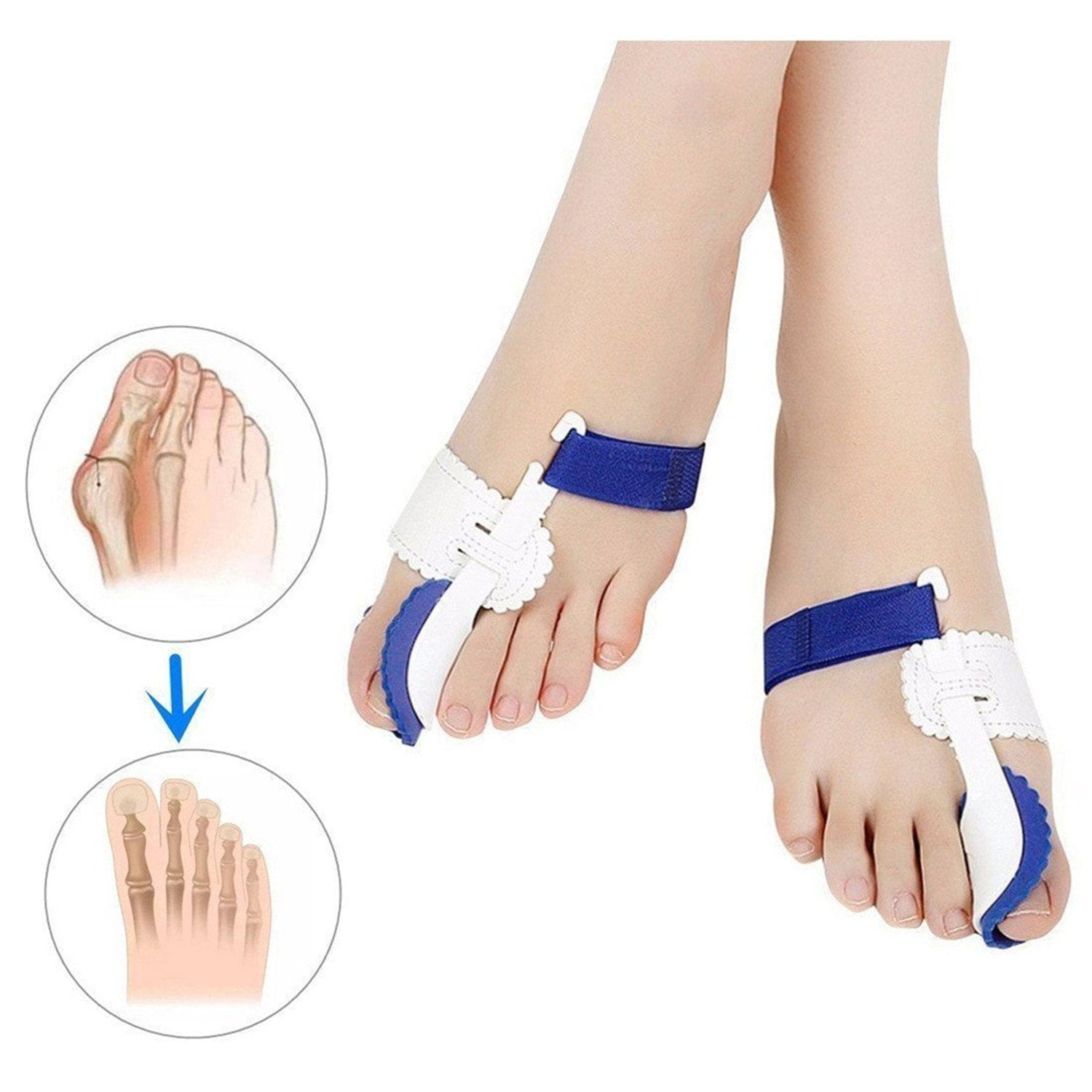 Orthopedic Bunion Corrector Splints - Non Surgical Treatment & Relief