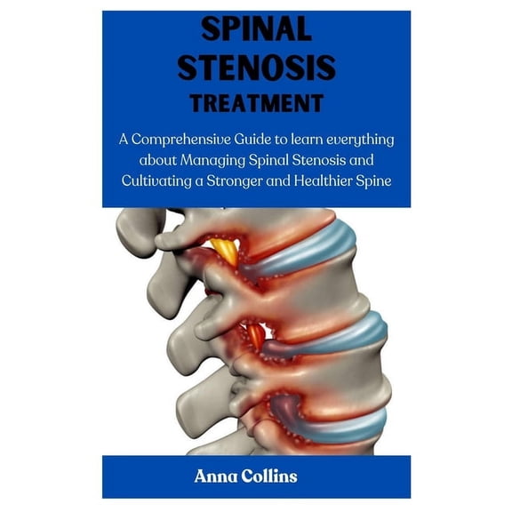 Spinal Stenosis Treatment: A Comprehensive Guide to learn everything about Managing Spinal Stenosis and Cultivating a Stronger and Healthier Spine (Paperback)