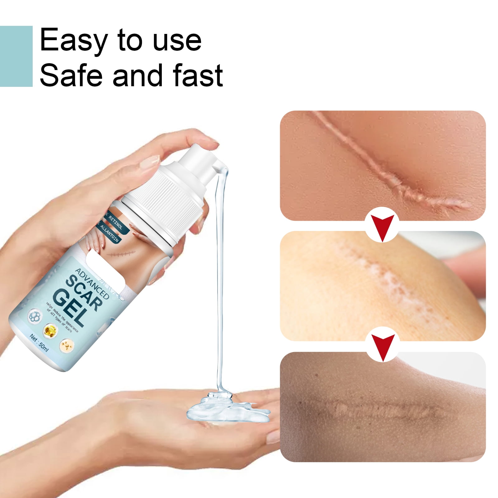 Alvantor Advanced Silicone Gel for Effective Scar Treatment  for both Old and New Scars, 1.69 fl. oz