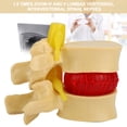 thumbnail image 4 of Modelo De Hernia De Disco Lumbar Humana, Práctica Profesional, Vértebras Lumbares Humanas Simuladas Degenerativas, Duraderas Para La Enseñanza Clínica De Ortopedia, 4 of 7