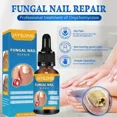 thumbnail image 2 of Gel para eliminar hongos en las uñas, crema antiinfección, 22 piezas, 10ML, 2 of 5