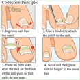 thumbnail image 3 of FS 12Pcs Ingrown Toenail Correction Pedicure Tool Elastic Patch Straightening Clip Caring, 3 of 5