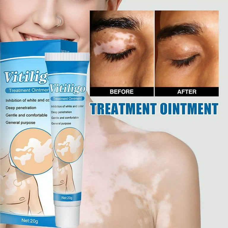 Vitiligo Removal Cream Vitiligo Care Ointment Skin Care 20g White Spot Remove Skin Care Cream Reduces White Spots On Skin Even Skin Tone Improve Skin