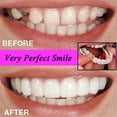 thumbnail image 3 of Snap on Smile Braces, Instantly Smile with Confidence, One Size Fits All, Natural Teeth Are Full Teeth Supported, Reusable, 3 of 5