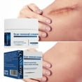 30g Scar Removal Face Body Creams Stretch Marks Remove Burn Cut Surgery