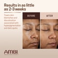 thumbnail image 4 of Crema facial Ambi Even & Clear Advanced para hiperpigmentación de 30 ml, 4 of 6