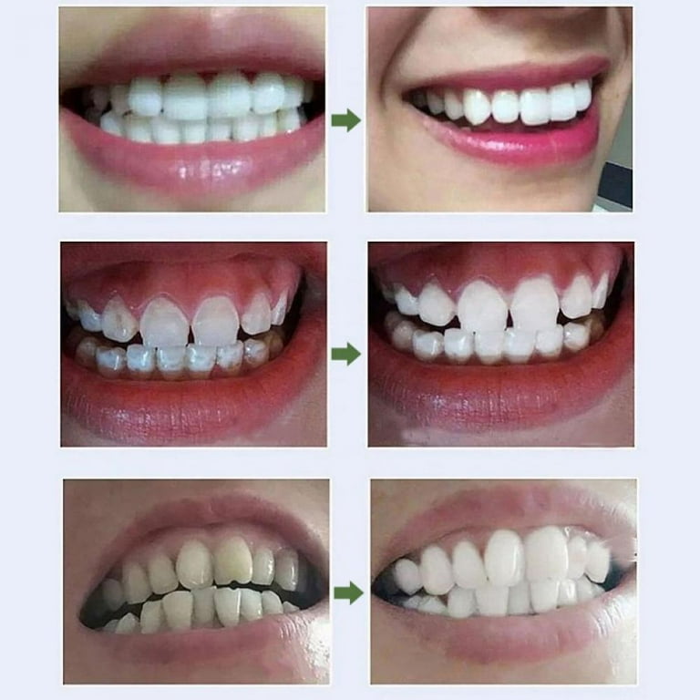 Not known Facts About Fast Snow Teeth Whitening
