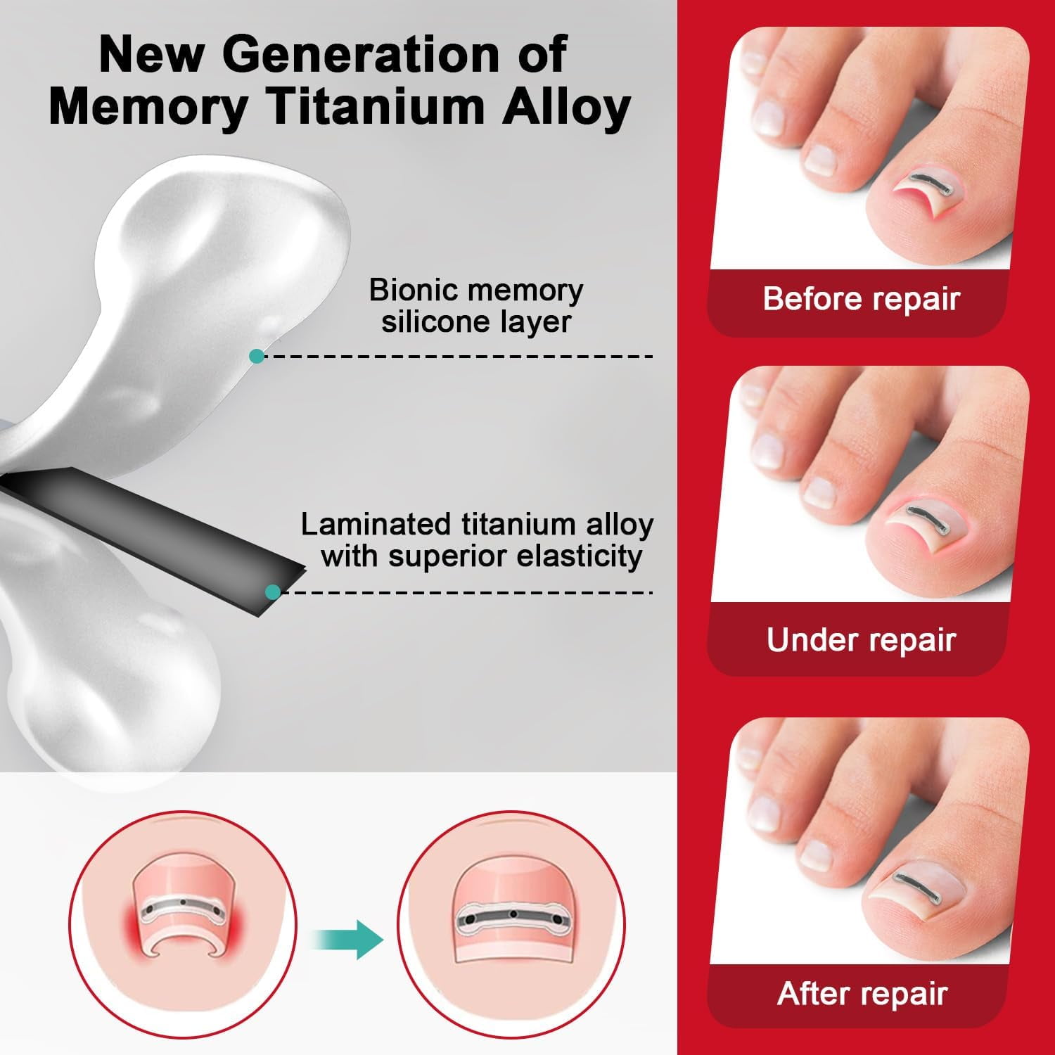 Unimiko Ingrown Toenail Corrector Kit & Curved Nail Repair : Quick & Easy Solution - 6 Pcs (0.71/0.75/0.79in) for Effective Treatment